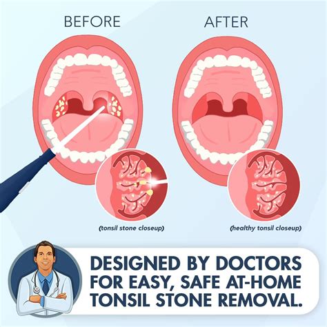 Tonsil stone removal kit near me - Let's talk about what causes tonsils stones, how to treat tonsil stones, and how to prevent tonsil stones! If you’re one of the small percentage of people to...